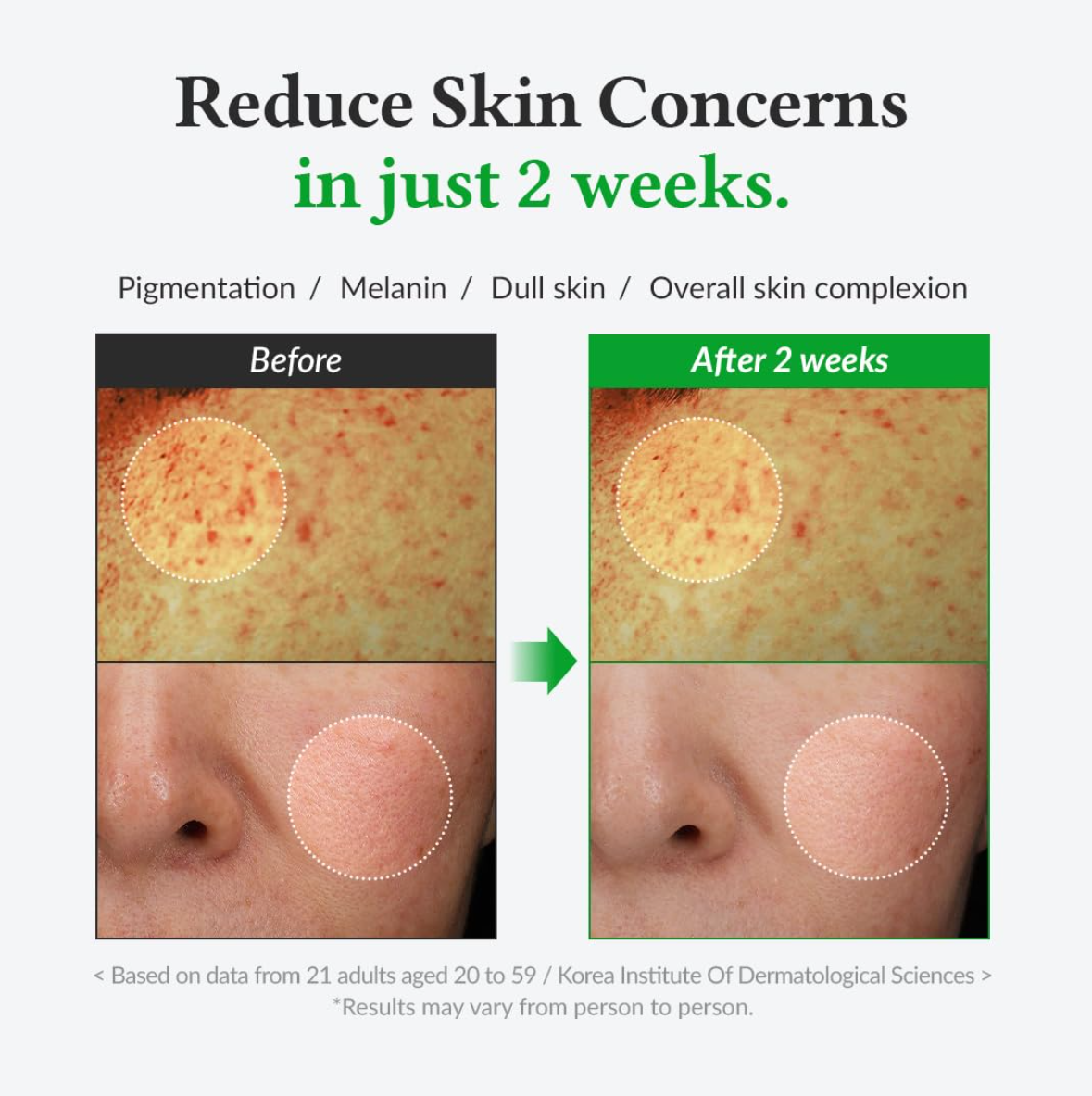 Before and after comparison of skin concerns with text indicating results in 2 weeks, Dr.althea Gentle Vitamin C Serum 30ml