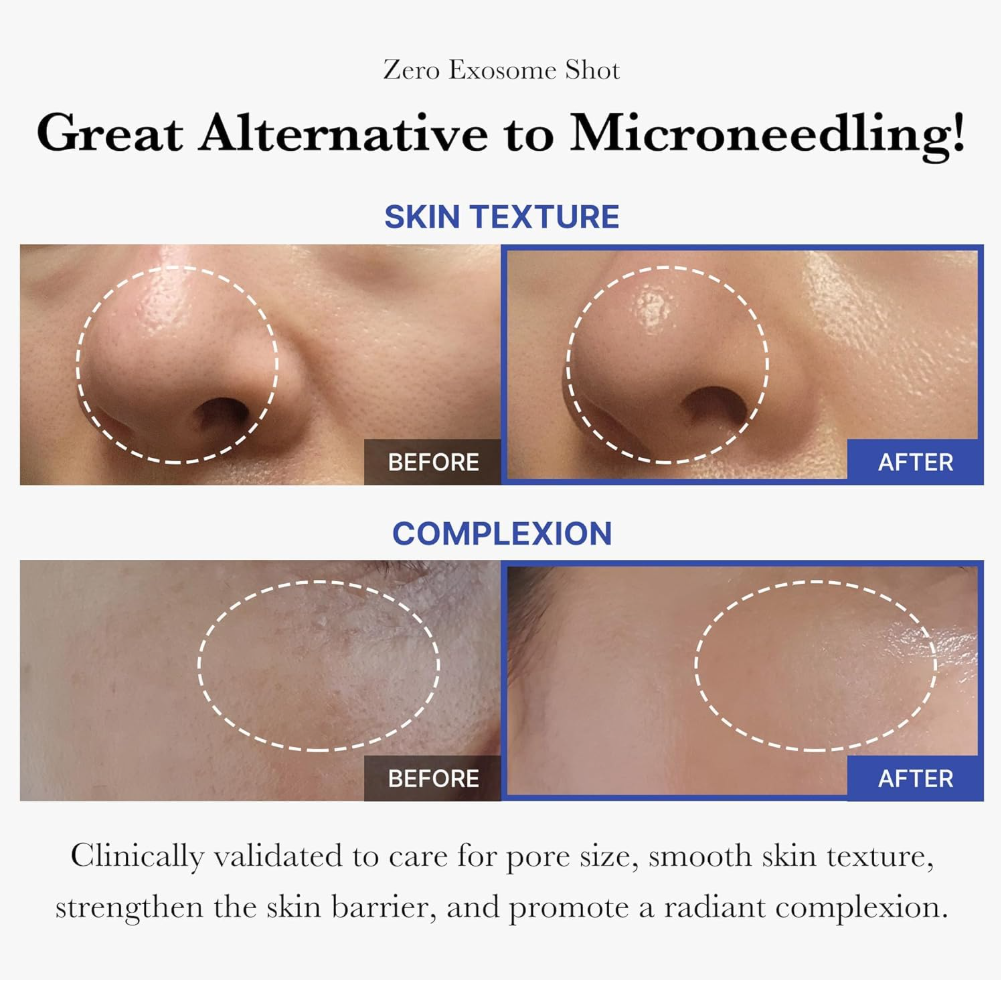Before and after comparison of skin texture and complexion with text highlighting benefits, Medicube One Day Exosome Shot Pore Ampoule 2000 30ml