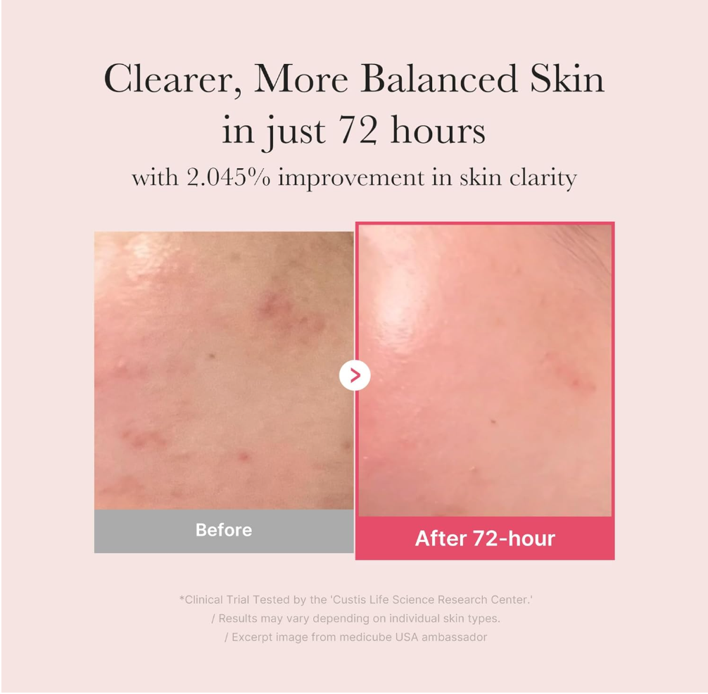 Before and after comparison of skin clarity with text on a beige background, Medicube TXA Niacinamide 15% Glow Serum 30ml