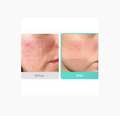 Before and after comparison of skin with acne treatment on a white background, Medicube Azelaic Acid 16 BB Soothing Serum 30ml