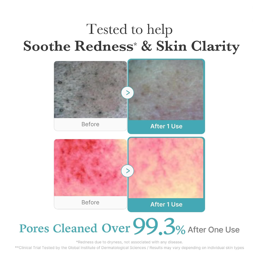 An informational graphic with before-and-after skin close-ups showing reduced redness and clearer skin after one use. Text reads 'Tested to help Soothe Redness & Skin Clarity' and 'Pores Cleaned Over 99, Medicube Azelaic Acid Niacinamide Deep Clean Foam Cleanser 120g