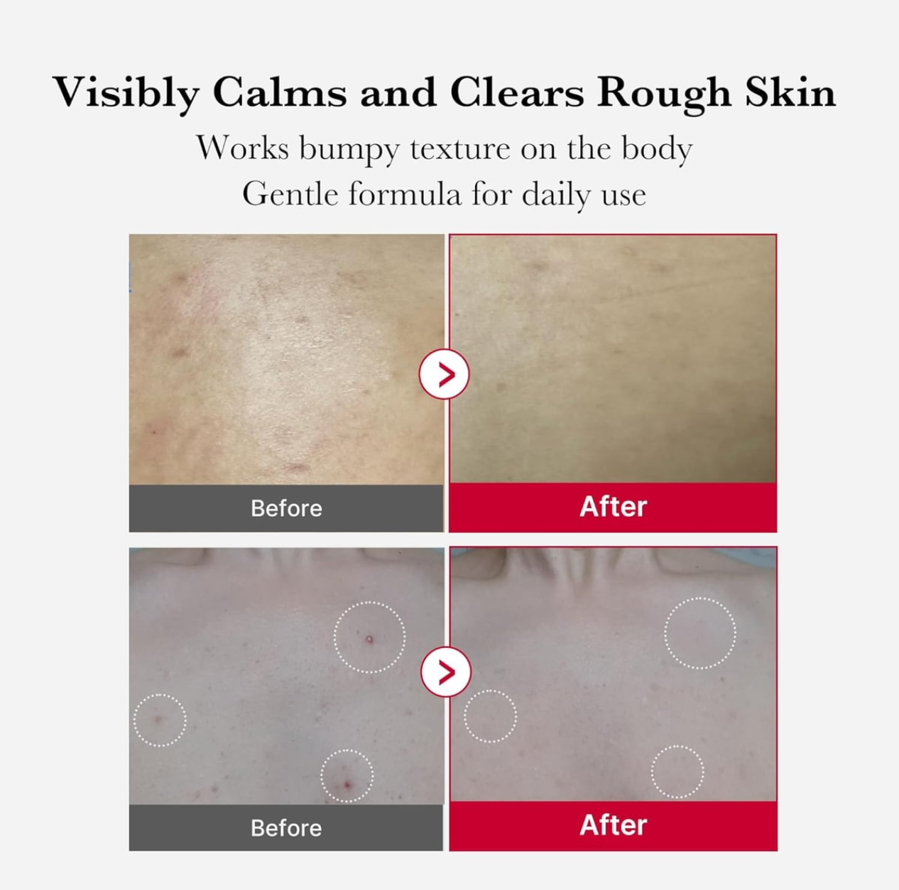 Before and after comparison of skin texture with text indicating product benefits, Medicube Red Acne Body Peeling Shot 110g