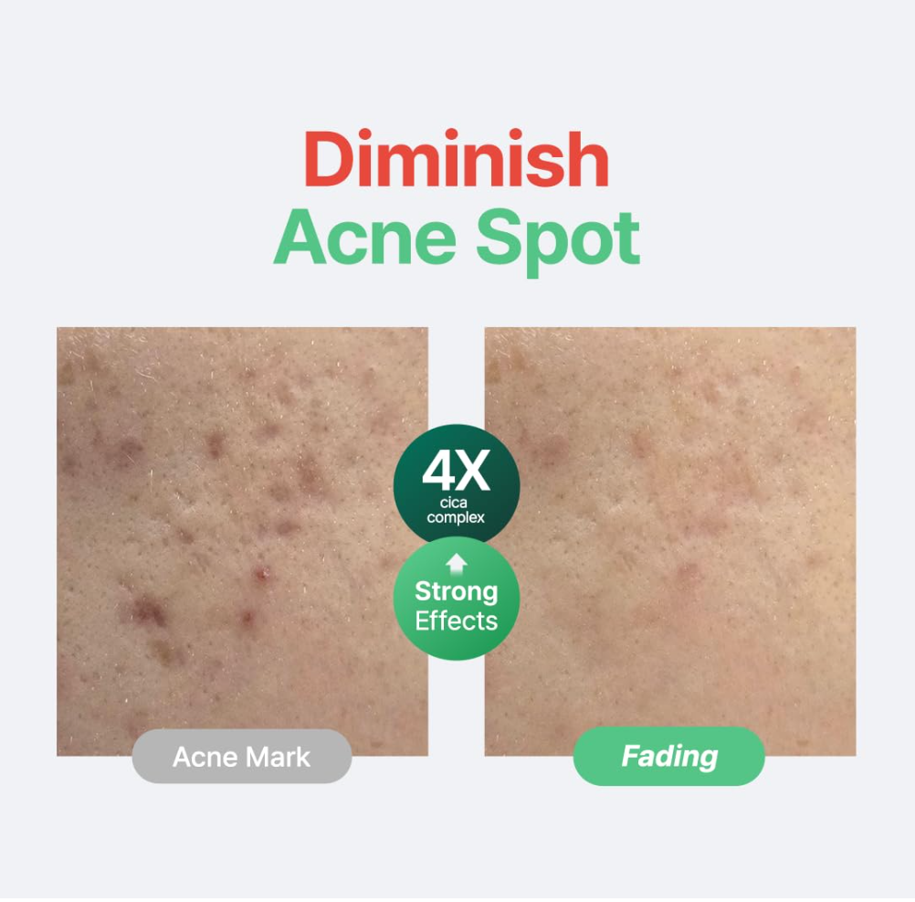 Before and after comparison of acne spot treatment with text 'Diminish Acne Spot' and product features, Purito SEOUL Wonder Releaf Centella Serum Unscented 60ml