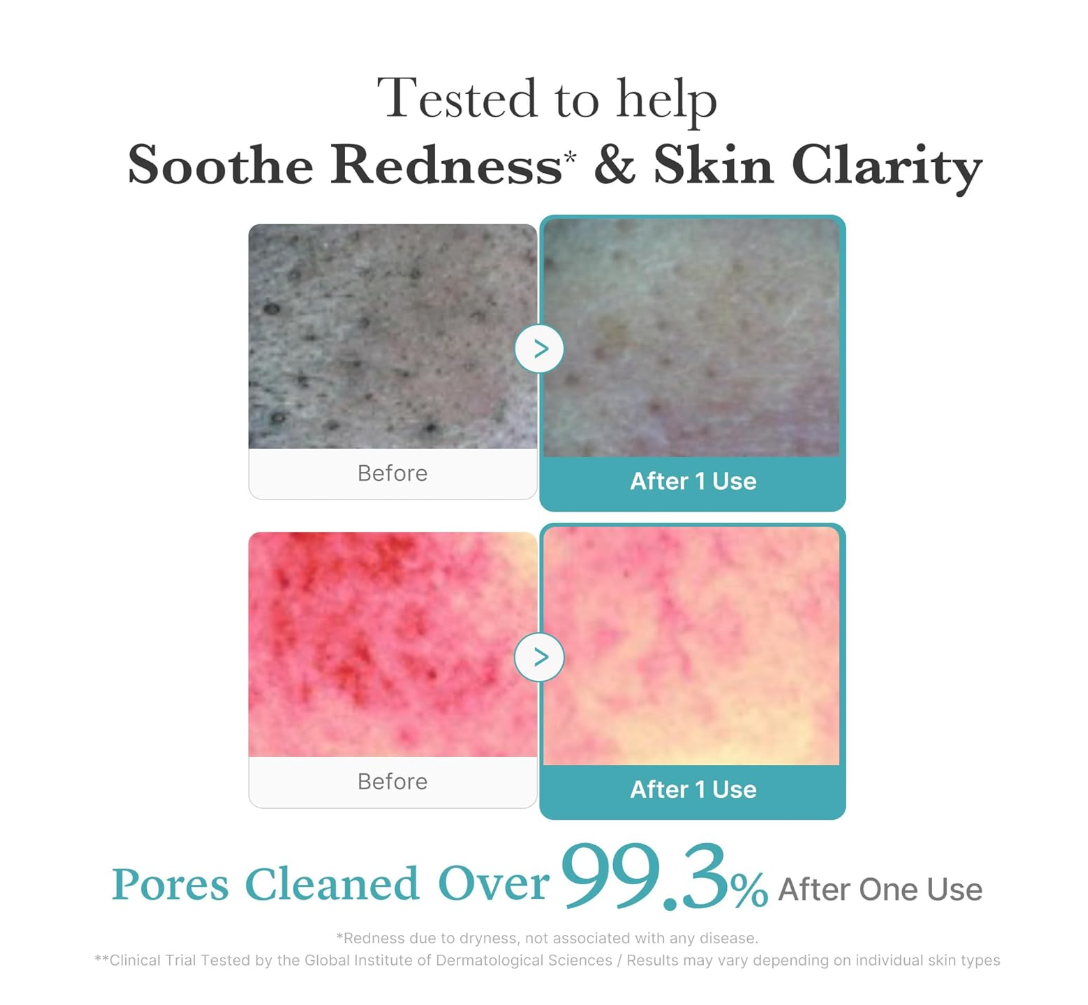 Before and after effects of a skincare product on skin redness and clarity with text indicating pore cleaning results, Medicube Azelacia Acid Niacinamide Deep Clean Foam Cleanser 120g