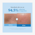 Before and after skin comparison showing 94.5% reduction of impurities with a blue background, Medicube Zero Pore Blackhead Deep Cleansing Oil 205ml