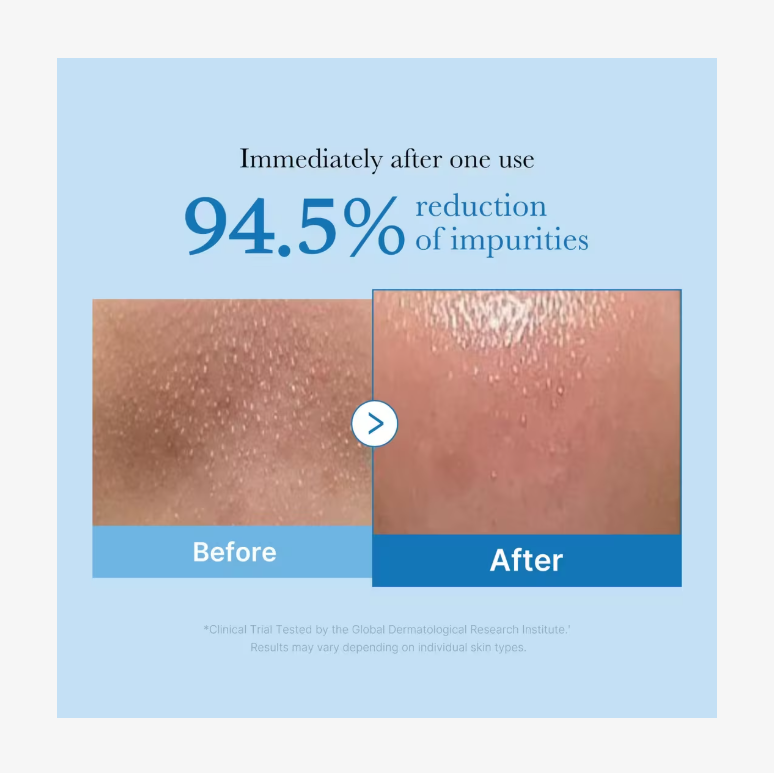 Before and after skin comparison showing 94.5% reduction of impurities with a blue background, Medicube Zero Pore Blackhead Deep Cleansing Oil 205ml