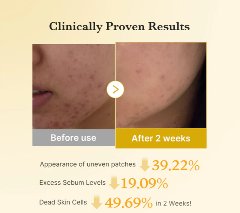 Before and after comparison of skin treatment showing clinical results on a beige background, Medicube Kojic Acid Turmeric Pad 160ml 70pads