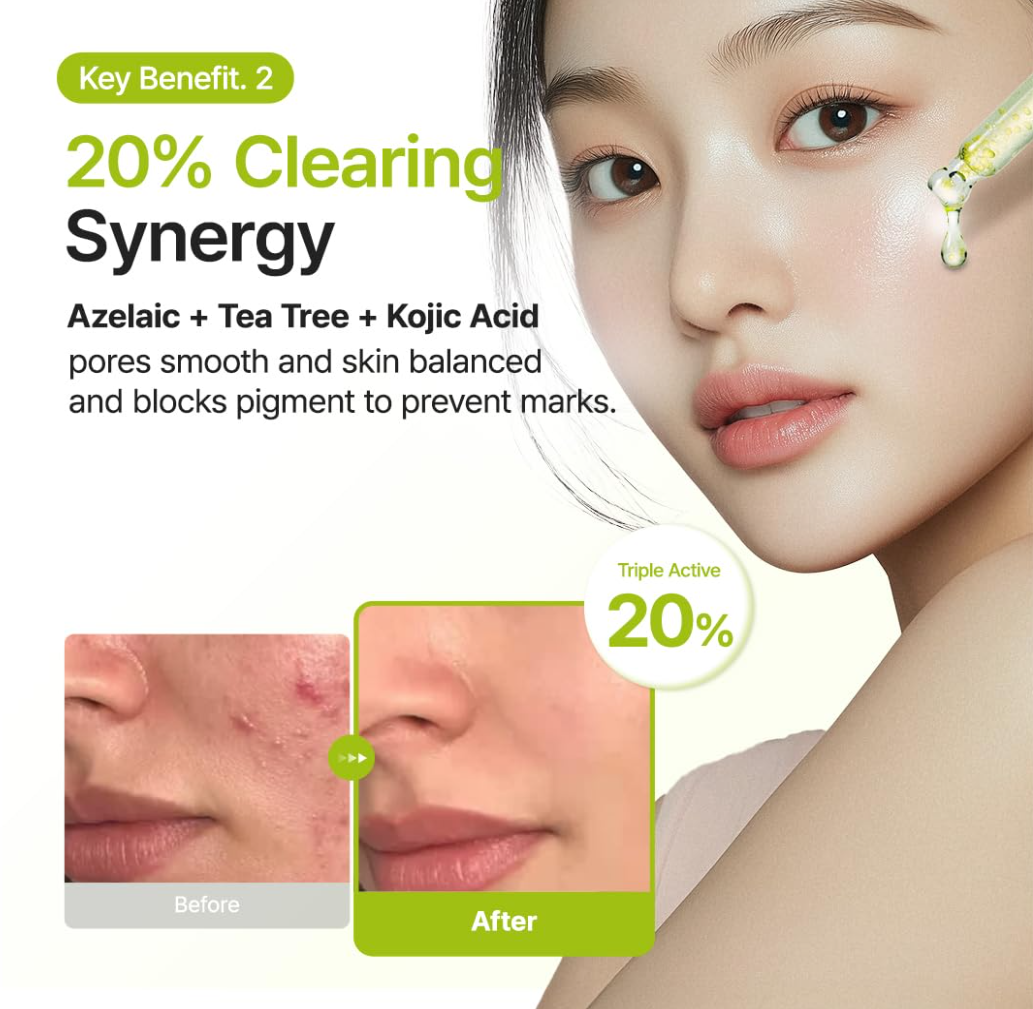 Advertisement for a skincare product with before and after effects on skin, featuring azelaic acid, tea tree, and kojic acid, Purito Azelaic Acid 10 Kojic Tea Tree Serum 30ml