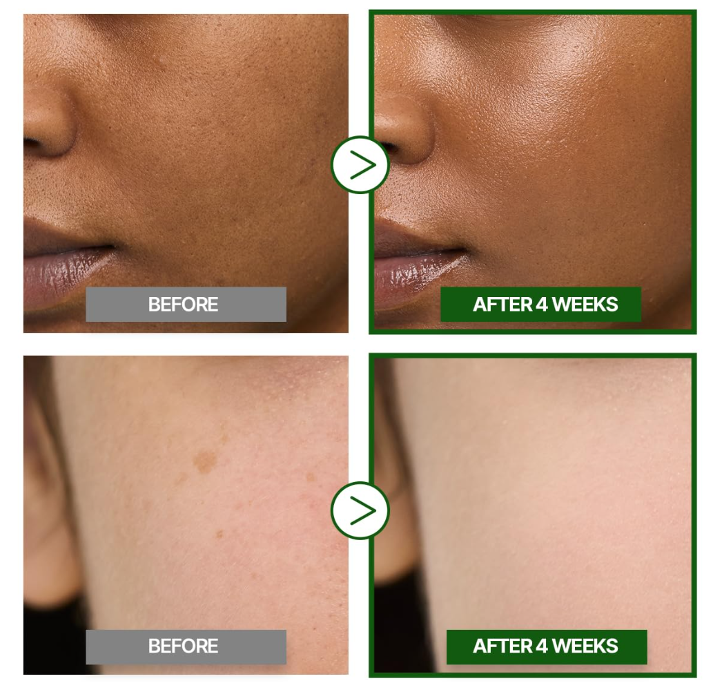 Before and after comparison of skin treatment on a person's face, showing visible improvement after 4 weeks, Goodal Vita-C Dark Spot Care Cream 50ml