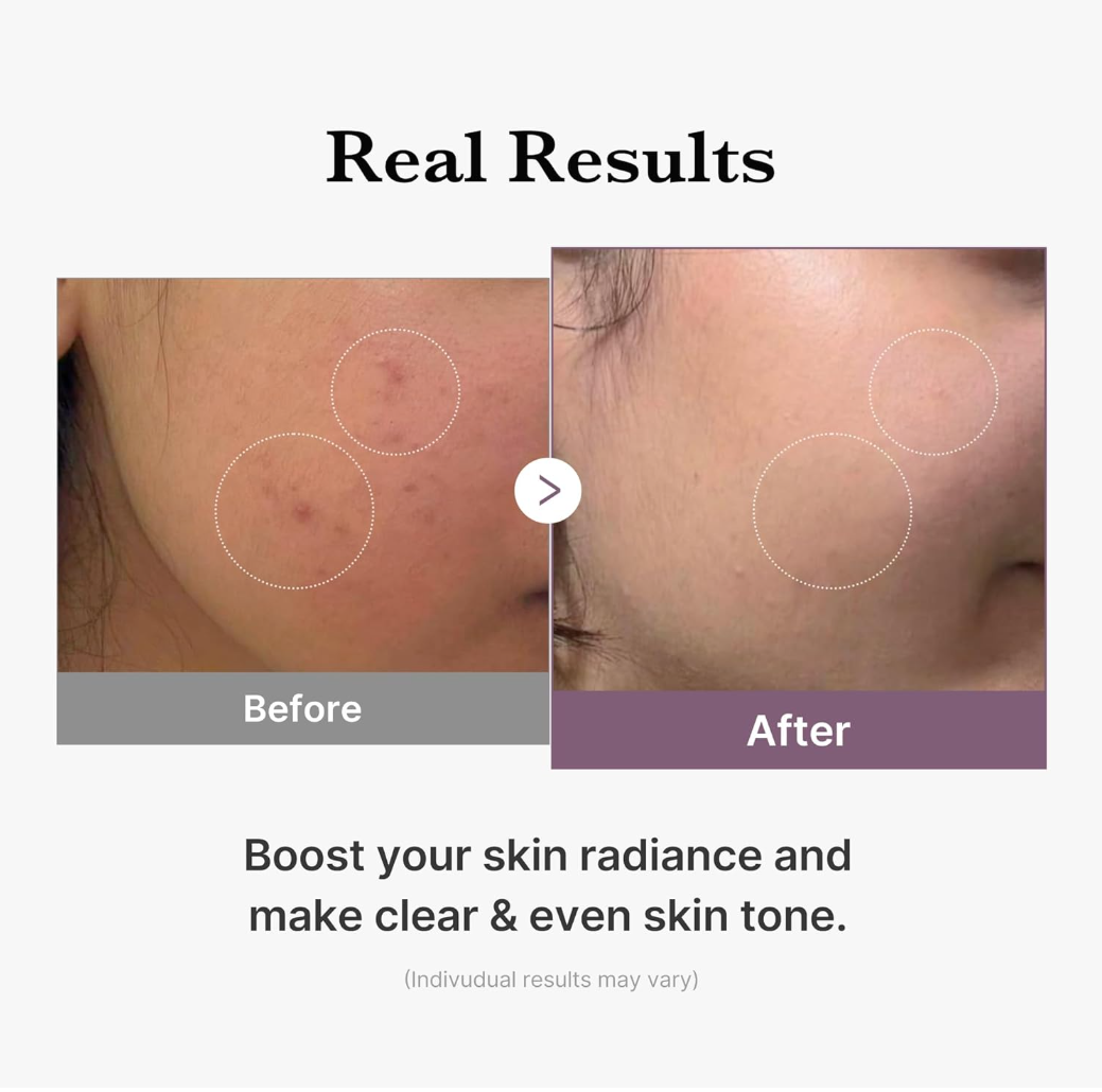 Before and after comparison of skin with blemishes, showing a clear and even skin tone, Medicube Age-R Glutathione Glow Toner 140ml