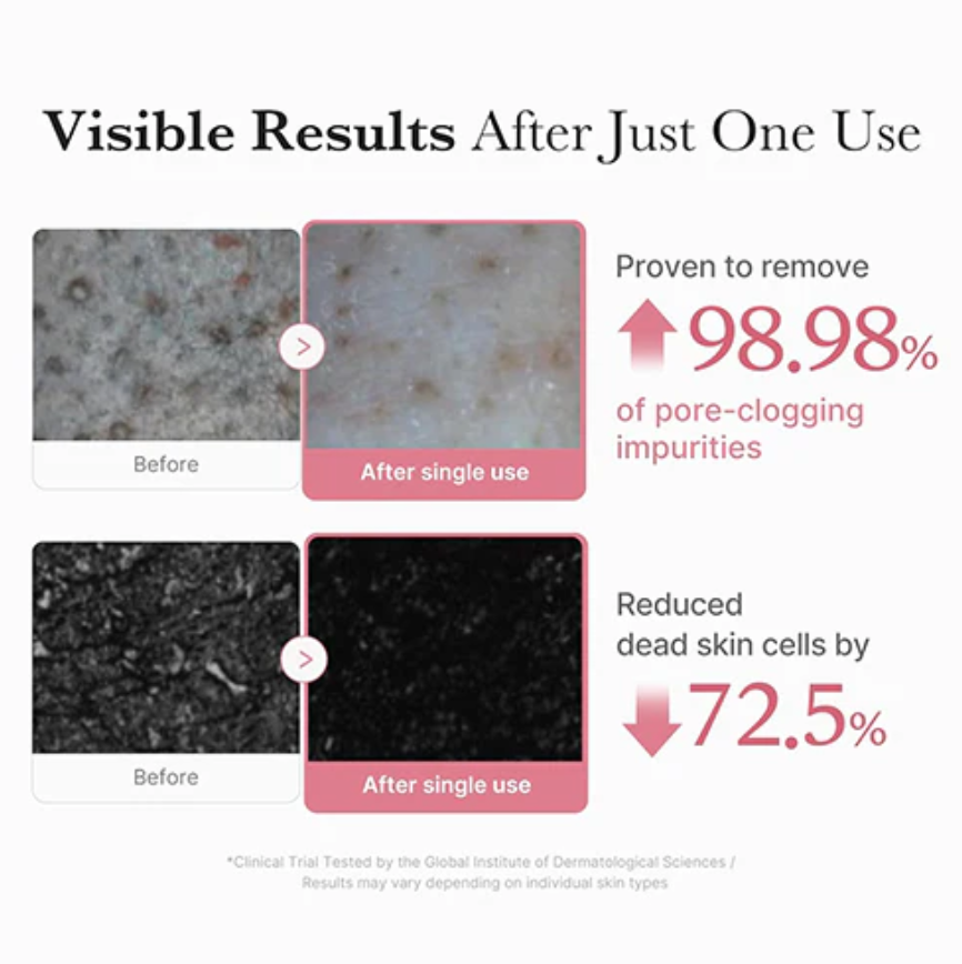 Before and after effects of a skincare product on skin impurities and dead skin cells, Medicube PDRN Pink Niacinamide Whip Cleanser 120g