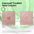 Before and after comparison of skin concern treatment with a green gradient background, Azelaic Acid 3 Cica Skin Clarifying Toner 250ml