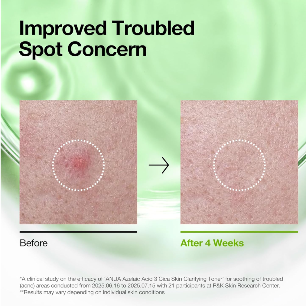Before and after comparison of skin concern treatment with a green gradient background, Azelaic Acid 3 Cica Skin Clarifying Toner 250ml