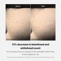 Before and after comparison of blackhead and whitehead count on skin with text indicating a 13% decrease, Medicube Zero Pore One Day Serum 30ml
