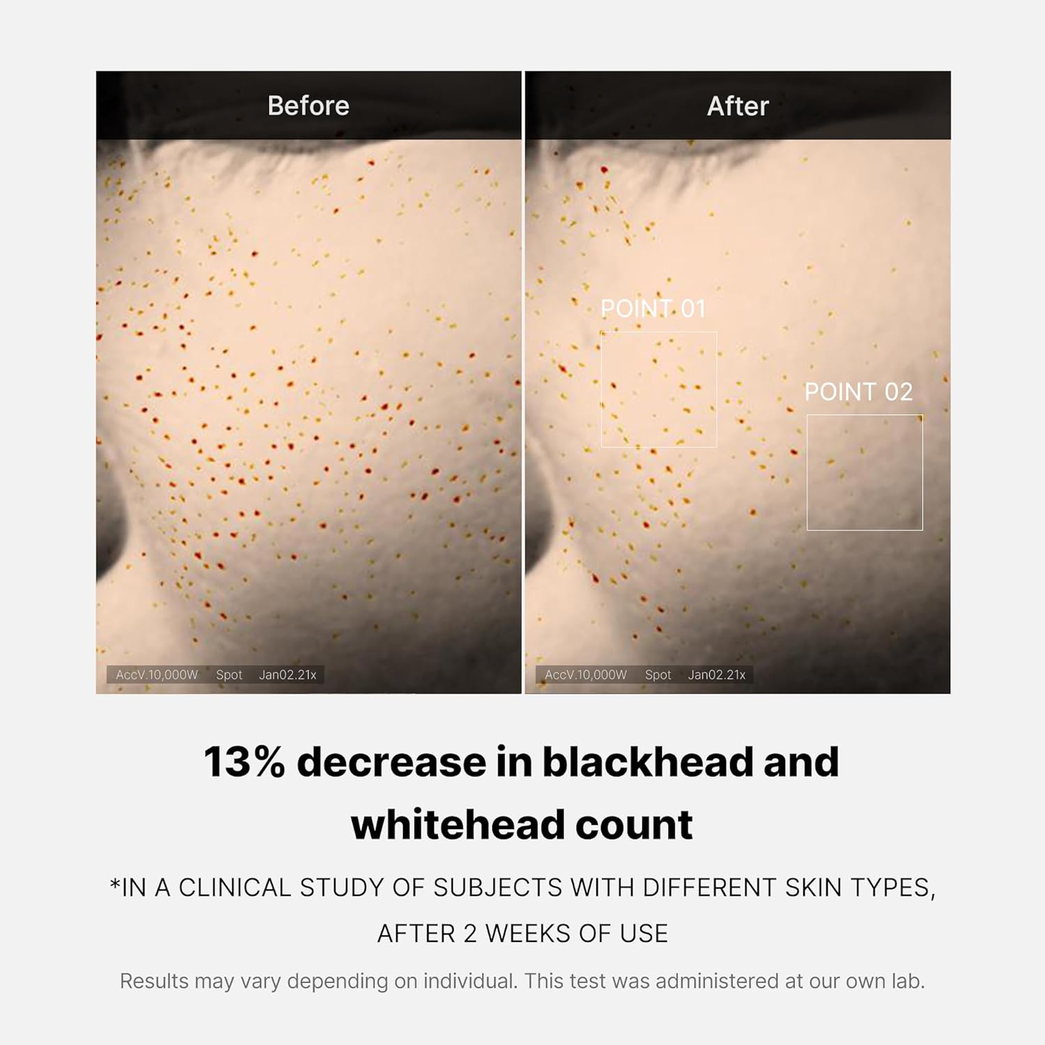 Before and after comparison of blackhead and whitehead count on skin with text indicating a 13% decrease, Medicube Zero Pore One Day Serum 30ml