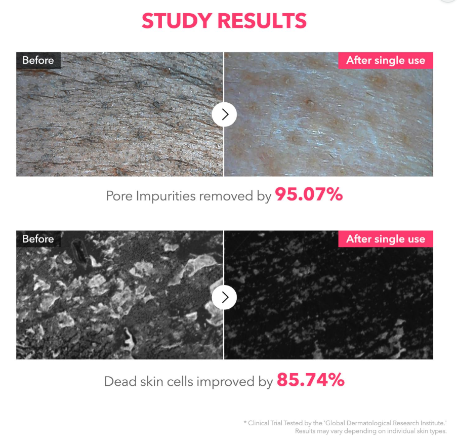 Before and after study results showing pore impurities and dead skin cells removal with a product, April Skin TXA Niacinamide 99 Deep Cleanser 120g