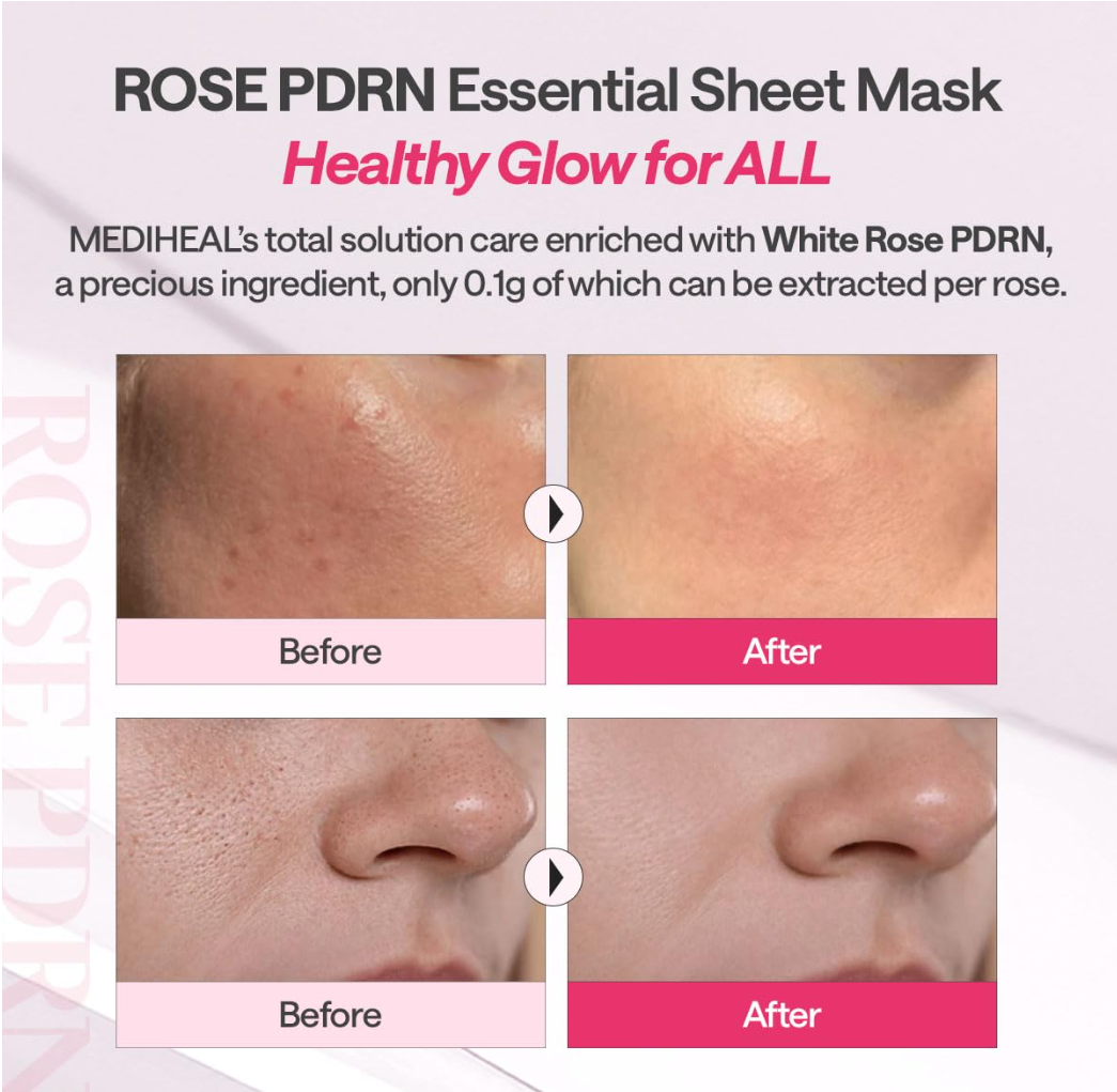 Advertisement for ROSE PDRN Essential Sheet Mask showing before and after effects on skin, Mediheal Rose PDRN Mask 10+1